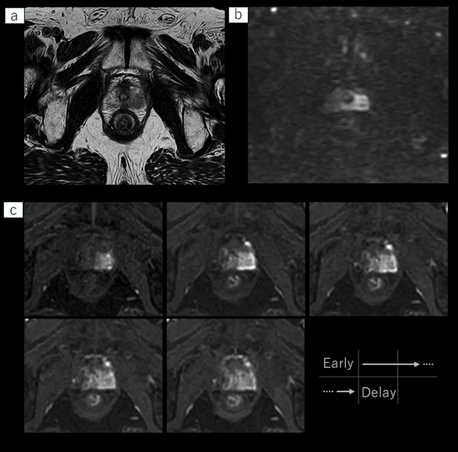 高分解能なT2WI（a）が2分台で撮影可能に。本症例ではDWI（b）にて高信号域、造影Dynamic（c）の早期濃染も認め、前立腺癌と診断された。