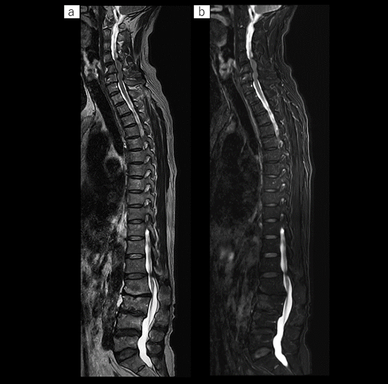 全脊椎では、Multi-contrast撮像により、1:55×2の撮像時間でT2WI（a）と脂肪抑制画像（b）が一度に取得可能。