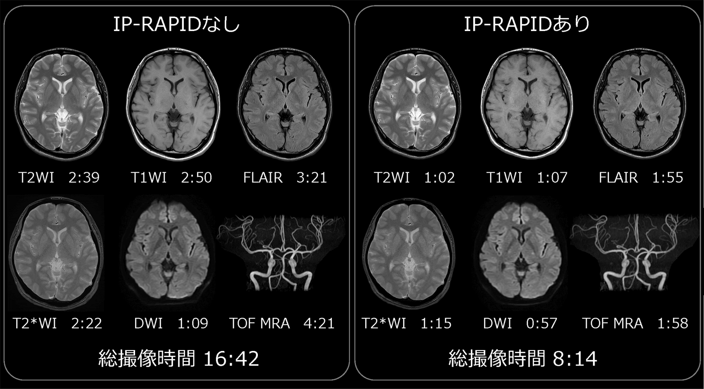 図４　頭部ルーチンプロトコルにおけるIP-RAPID有無の比較（磁場強度1.5T 超電導MRI）IP-RAPIDを適用することにより、撮像時間が半分以下となっても、IP-RAPID非適用時と同程度の画質が得られている。