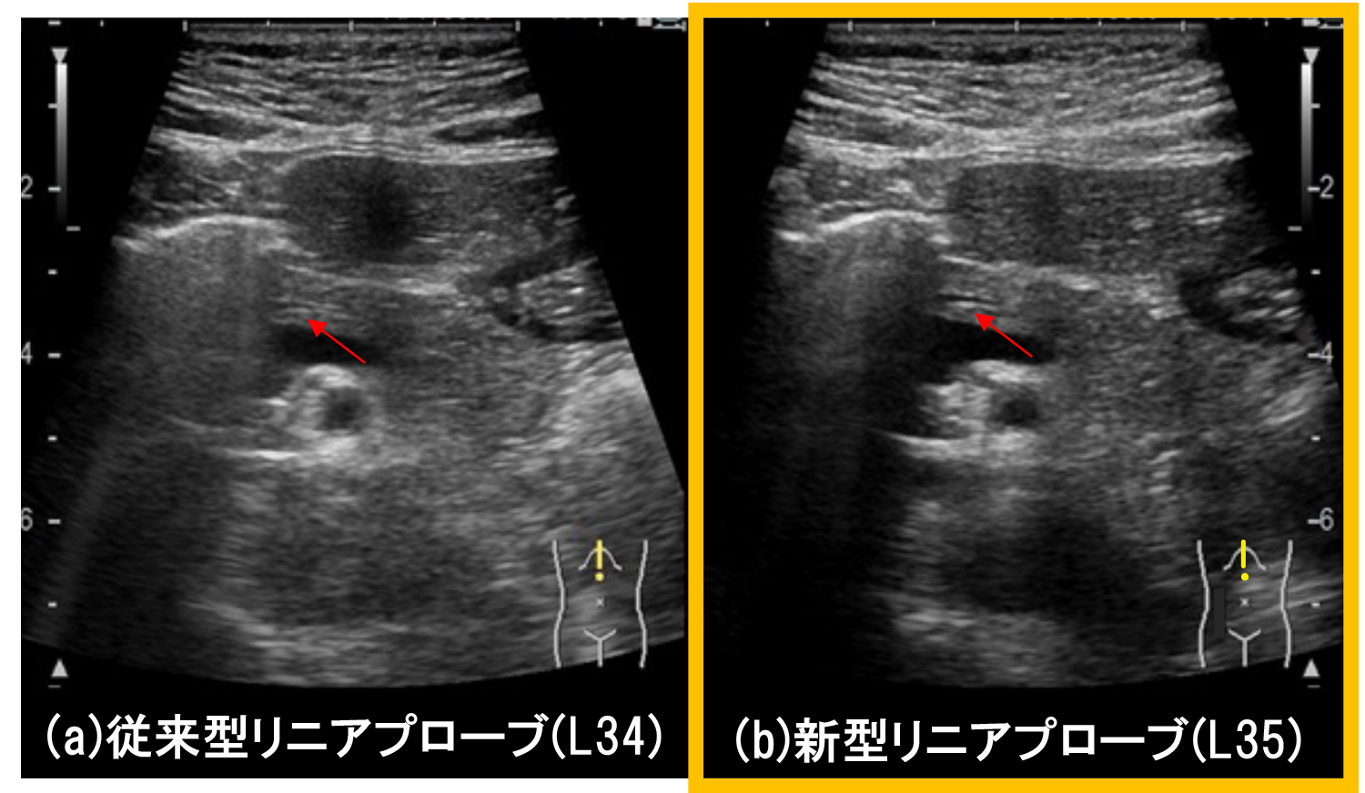 図5 主膵管（赤矢印）画像